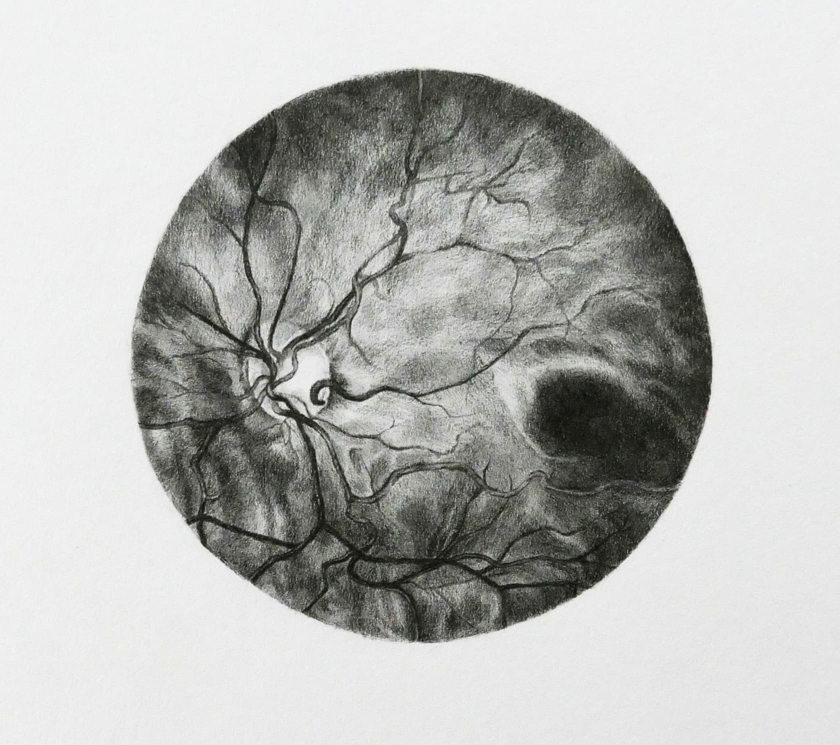 A detailed black and white drawing of a human retina with visible blood vessels and optic disc.